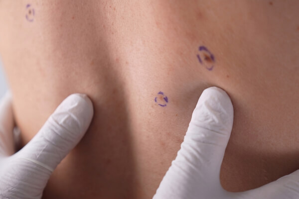 Clinician examining marked spots on a patient’s back during a skin check